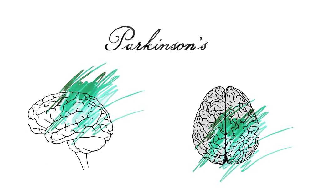 parkinsons