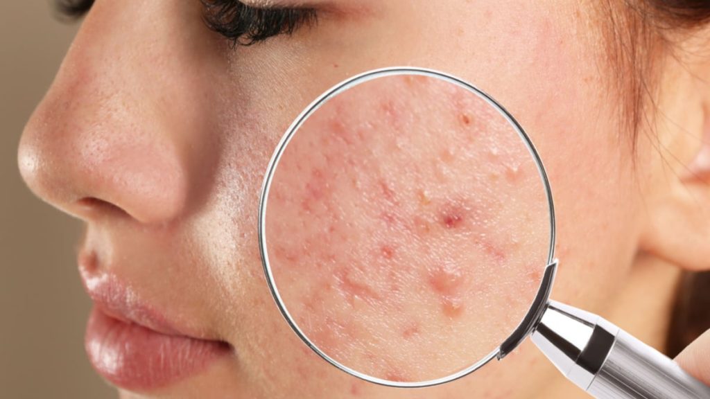 acnee-cauze-tratament