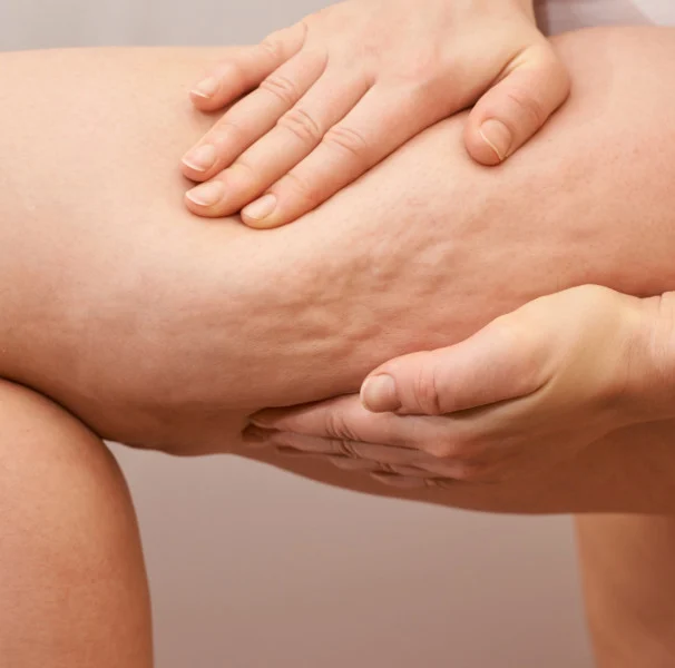 imagem-aproximada-de-celulites-em-perna-feminina-amp_hero-1