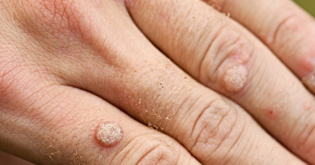 negi-tipuri-cauze-tratamente-eficiente-si-preventie-veruci-vulgare