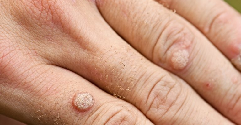 negi-tipuri-cauze-tratamente-eficiente-si-preventie-veruci-vulgare