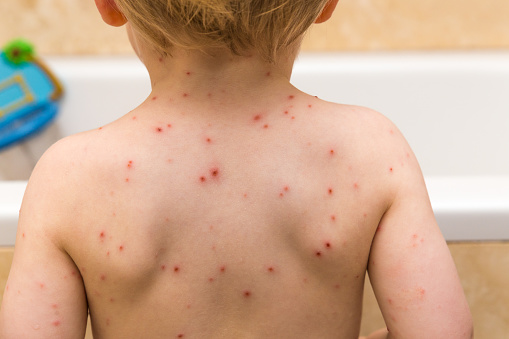 Chicken Pox on a toddler