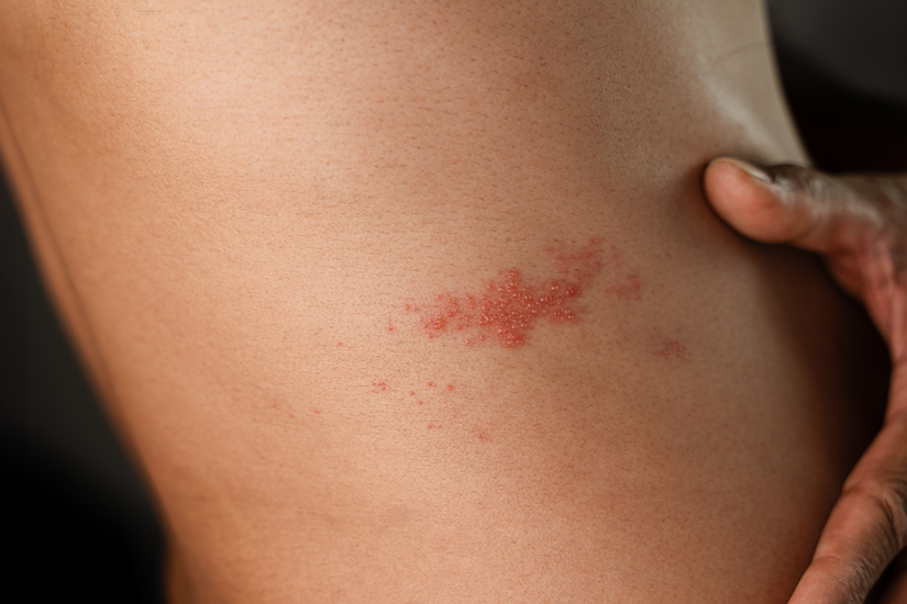 zona zoster simptom cutanat